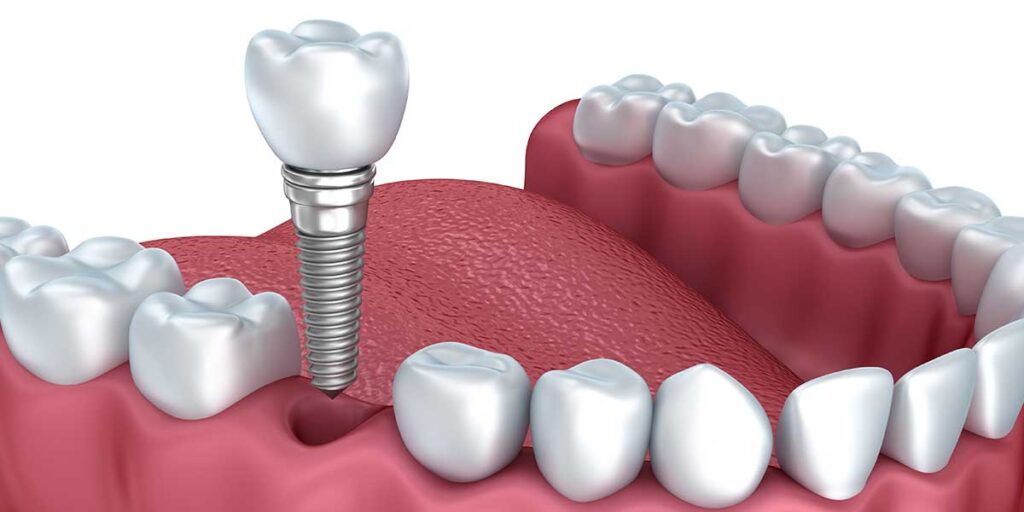 Dental Implants in Palmdale