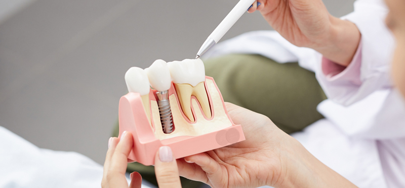 dental implants near me