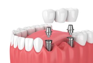 dental implant provider in Agoura Hills
