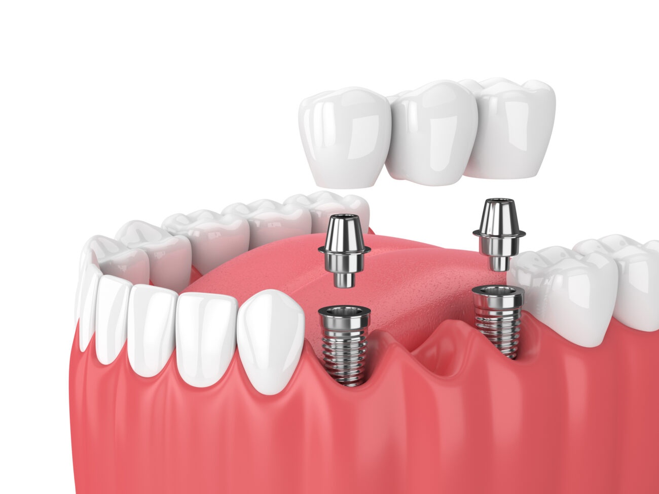 dental implant provider in Agoura Hills