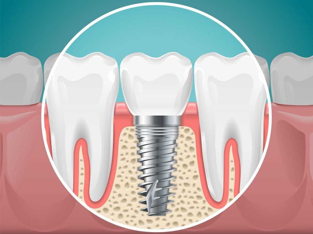 Implants in Agoura Hills