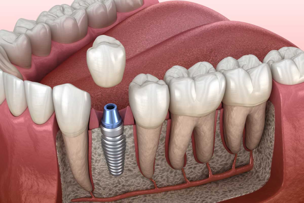 implants in Agoura Hills
