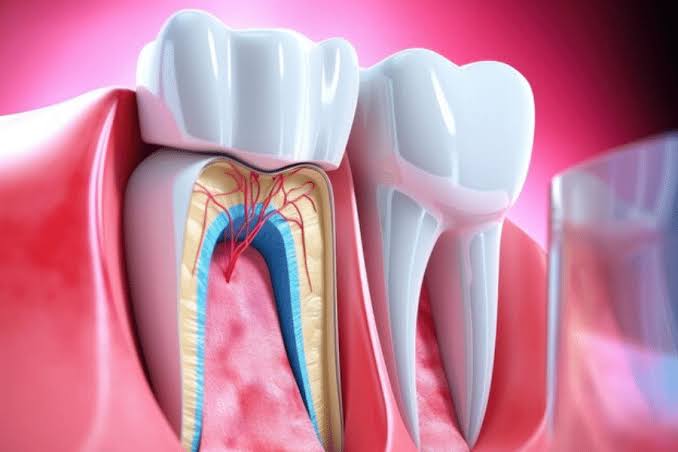 Root canal in los angeles
